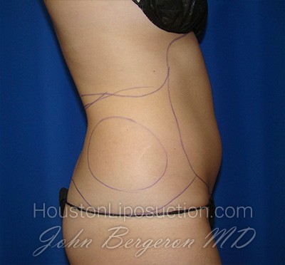 Liposuction Before & After Patient #1714