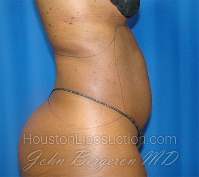 Liposuction Before & After Patient #1723