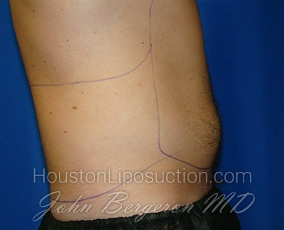 Liposuction Before & After Patient #1745