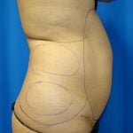 Liposuction Before & After Patient #1752