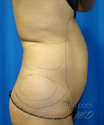 Liposuction Before & After Patient #1752