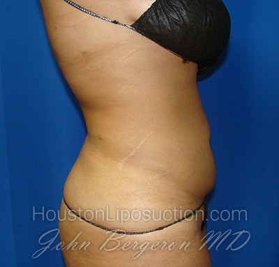 Liposuction Before & After Patient #1677