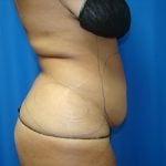 Liposuction Before & After Patient #1677