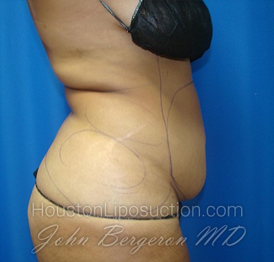 Liposuction Before & After Patient #1677