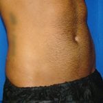 Liposuction Before & After Patient #1700