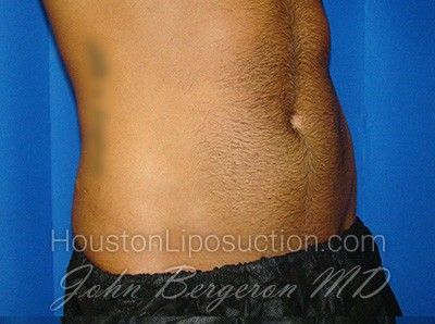 Liposuction Before & After Patient #1700