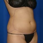 Liposuction Before & After Patient #1714