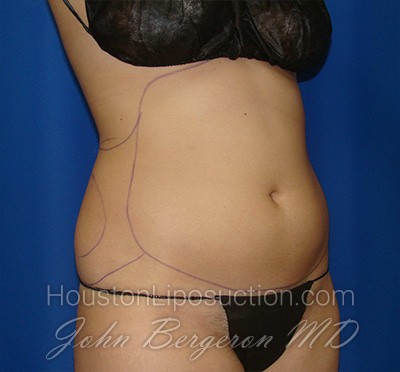 Liposuction Before & After Patient #1714