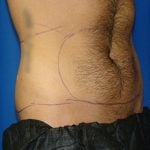 Liposuction Before & After Patient #1700