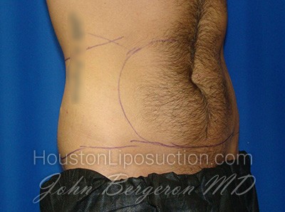 Liposuction Before & After Patient #1700