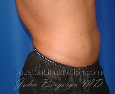 Liposuction Before & After Patient #1738