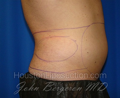 Liposuction Before & After Patient #1738