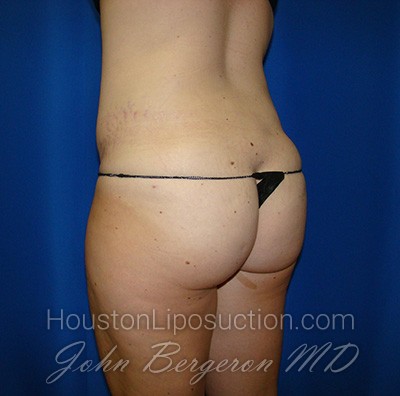 Liposuction Before & After Patient #1655