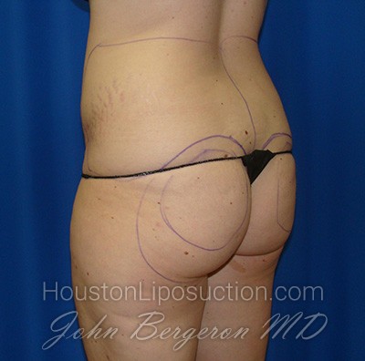 Liposuction Before & After Patient #1655