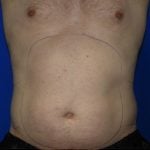 Liposuction Before & After Patient #1918