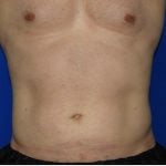 Liposuction Before & After Patient #1918