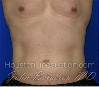 Liposuction Before & After Patient #1918