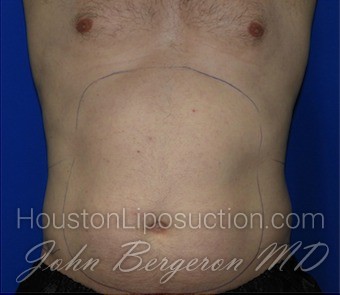 Liposuction Before & After Patient #1918