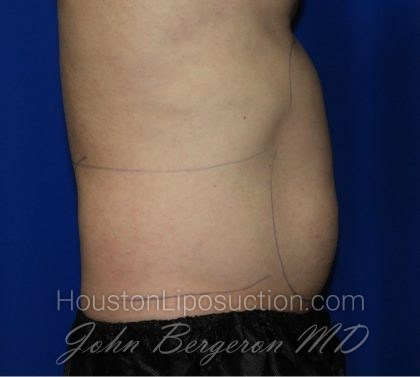 Liposuction Before & After Patient #1918