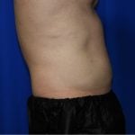 Liposuction Before & After Patient #1918