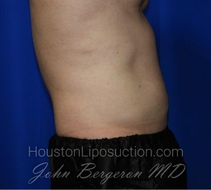 Liposuction Before & After Patient #1918