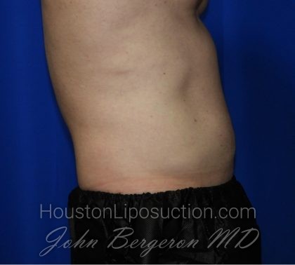 Liposuction Before & After Patient #1918
