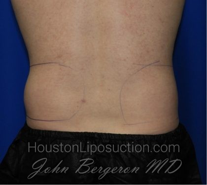 Liposuction Before & After Patient #1918