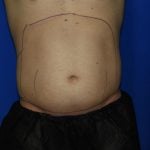 Liposuction Before & After Patient #1925