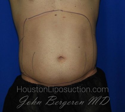 Liposuction Before & After Patient #1925