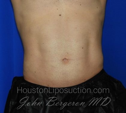 Liposuction Before & After Patient #1925