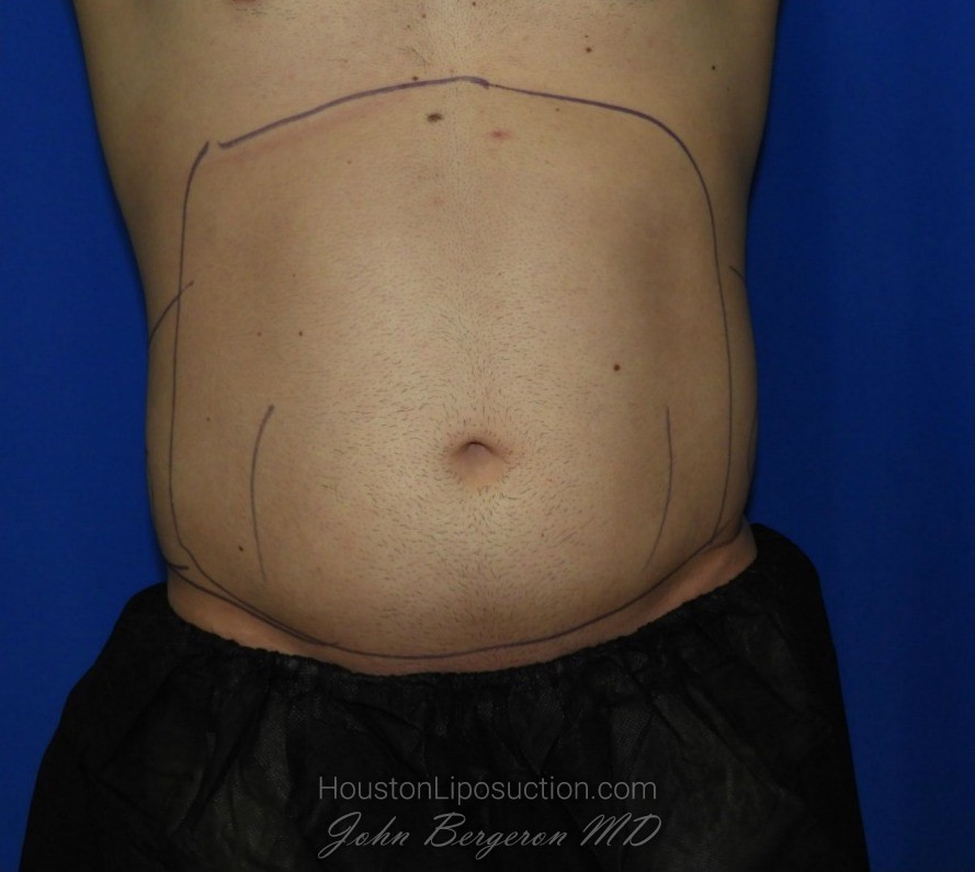Liposuction Before & After Patient #1925