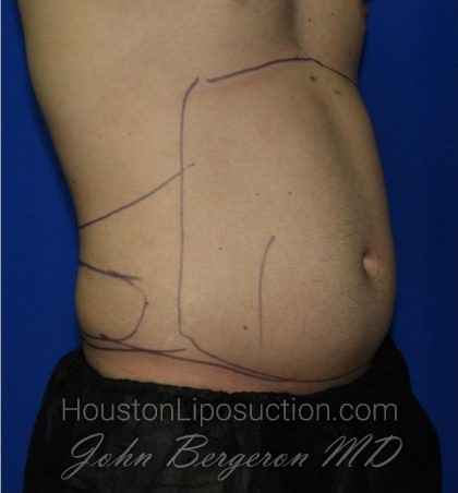 Liposuction Before & After Patient #1925
