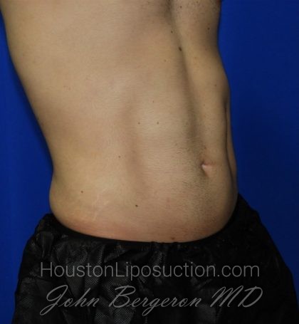 Liposuction Before & After Patient #1925