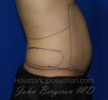 Liposuction Before & After Patient #1925