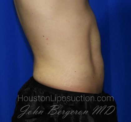 Liposuction Before & After Patient #1925