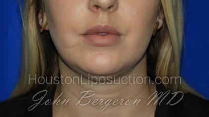 Liposuction Before & After Patient #1912