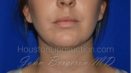 Liposuction Before & After Patient #1912