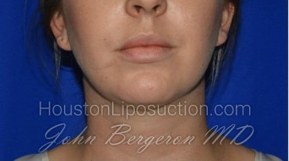 Liposuction Before & After Patient #1912