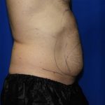 Liposuction Before & After Patient #1932