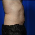 Liposuction Before & After Patient #1932