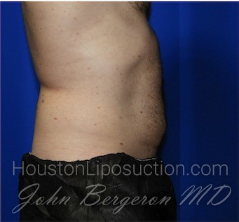 Liposuction Before & After Patient #1932