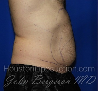 Liposuction Before & After Patient #1932