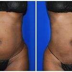 Liposuction Before & After Patient #1993