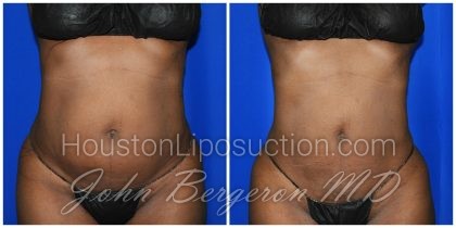 Liposuction Before & After Patient #1993