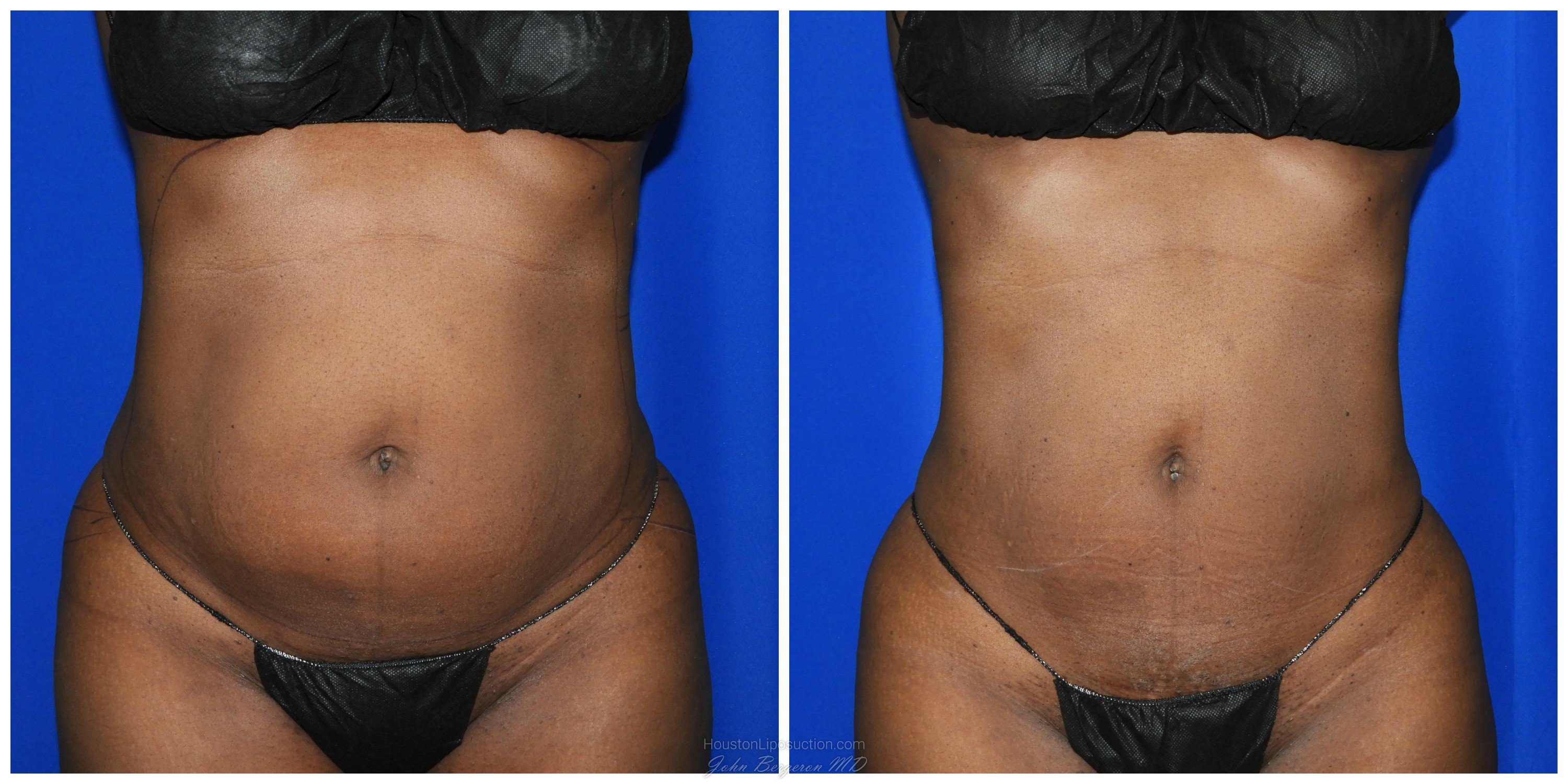 Liposuction Before & After Patient #1993