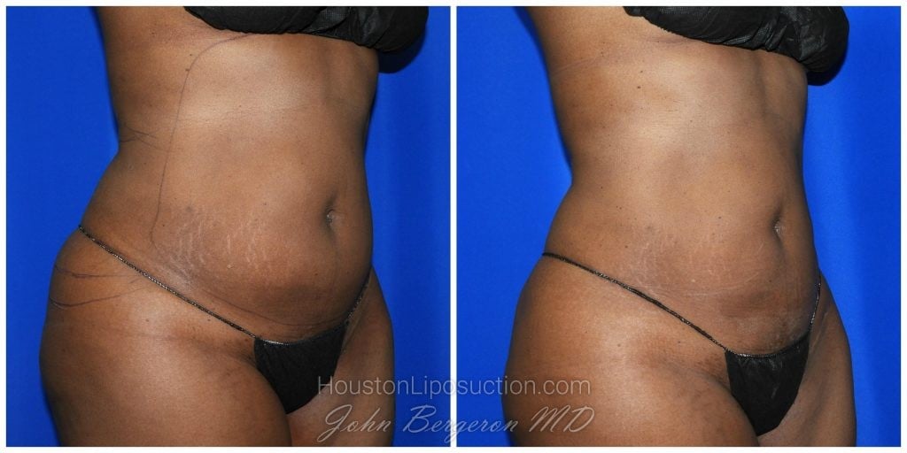 liposuction houston TX