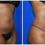 Liposuction Before & After Patient #1993