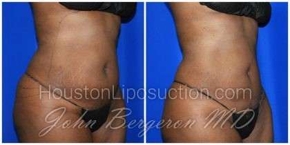 Liposuction Before & After Patient #1993