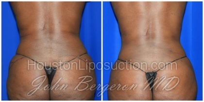 Liposuction Before & After Patient #1993