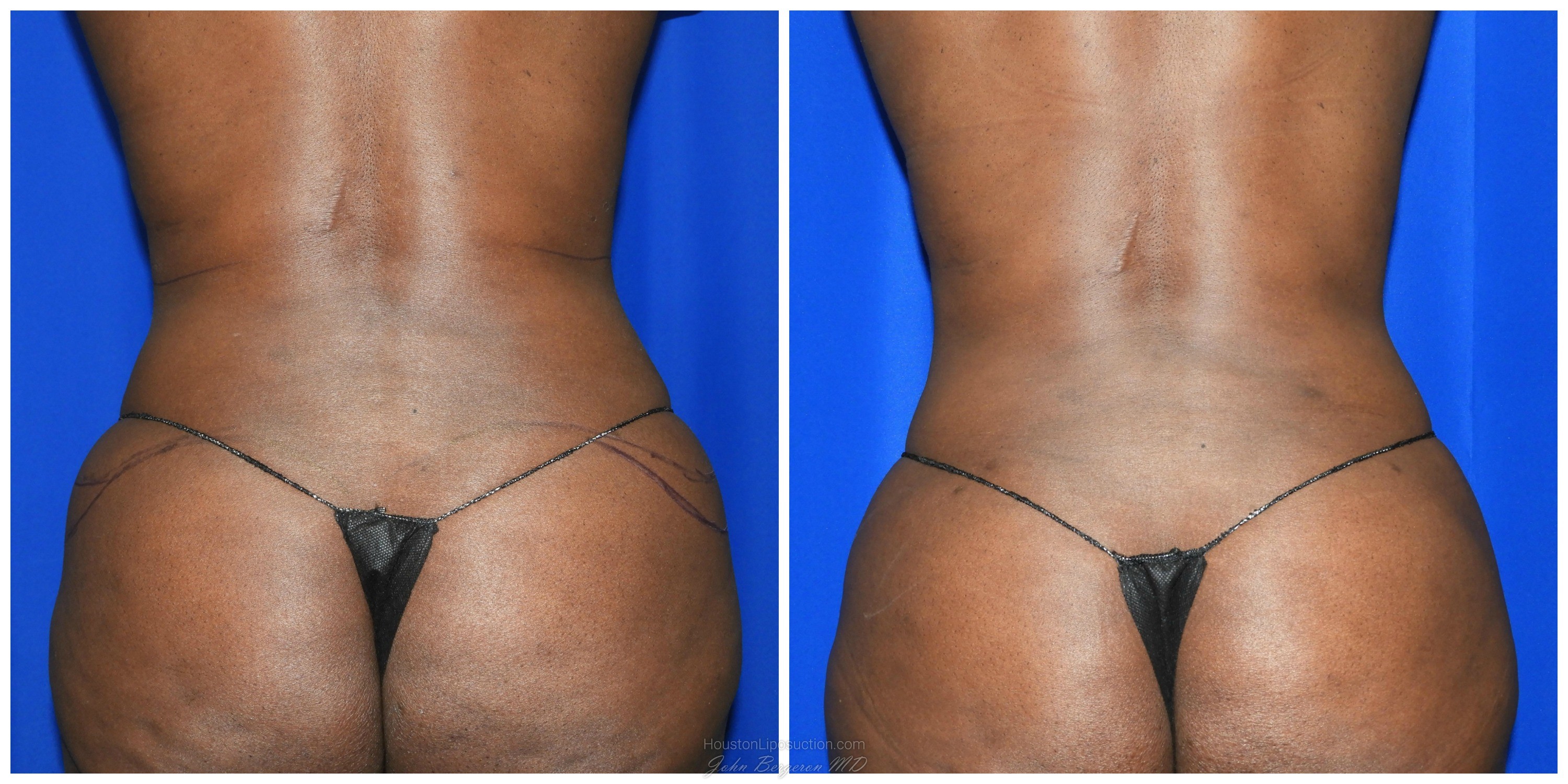 Liposuction Before & After Patient #1993
